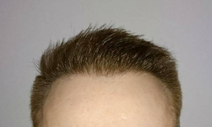نتائج زراعة الشعر بعد 6 شهور