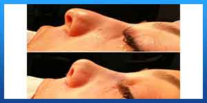 rhinoplasty in shiraz