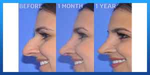 Rhinoplasty healing stages