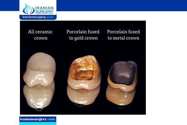 Materials Used for Making Dental Crowns