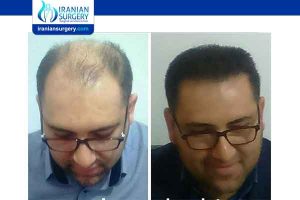 كم تكلفة زراعة الشعر في ايران؟
