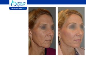 Facelift surgery in Iran before and after