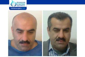 كم تكلفة زراعة الشعر في ايران؟