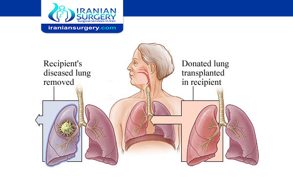 Lung Transplant procedure
