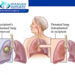 A lung transplant