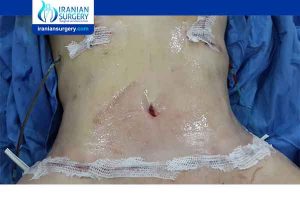 tummy tuck risks and side effects