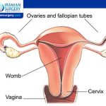 Abdominal hysterectomy