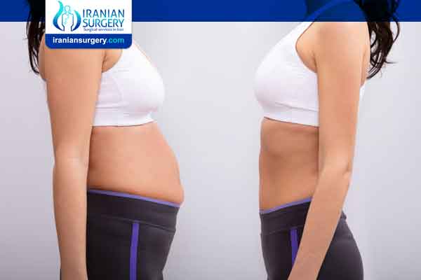 Abdominoplasty vs liposuction