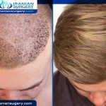 After a hair transplant