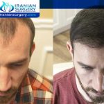 After a hair transplant