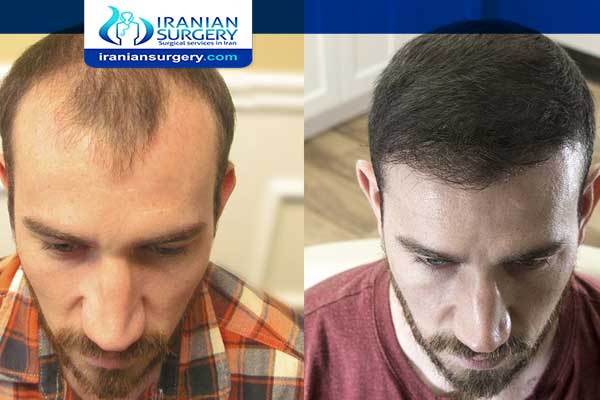 After a hair transplant