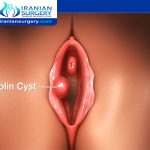 Bartholin cyst drainage aftercare