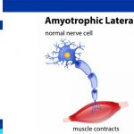 Amyotrophic Lateral Sclerosis