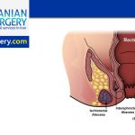 Anal fistula surgery in Iran