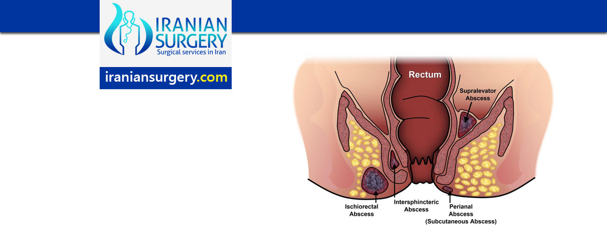 Anal fistula surgery in Iran