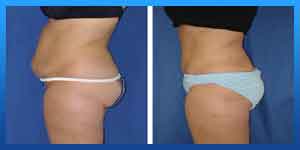 is liposuction dangerous