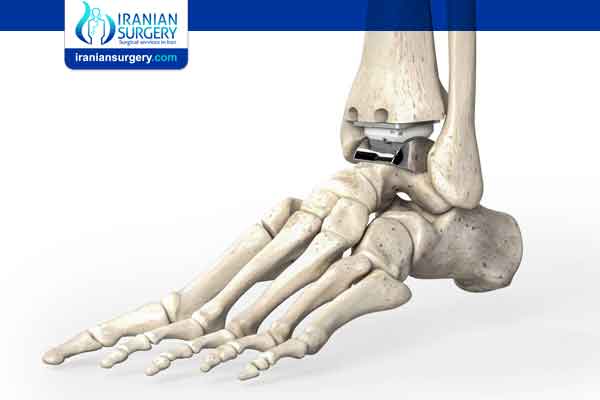 Ankle Replacement Options