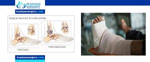 Ankle Replacement VS Ankle Fusion