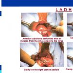 Anterior colpotomy procedure