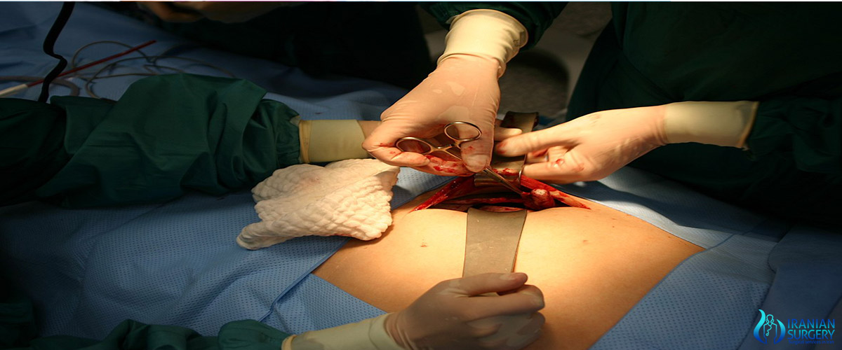 Appendix surgery in Iran