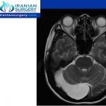 what is considered a large arachnoid cyst