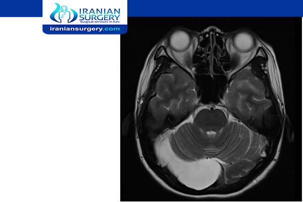 what is considered a large arachnoid cyst
