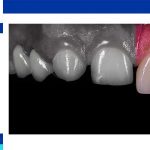 Are composite veneers permanent