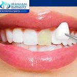 Are veneers permanent or removable