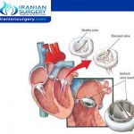 صمامات القلب الاصطناعية