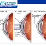 استجماتيزم بعد الليزك