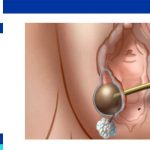 Bartholin cyst surgery marsupialization