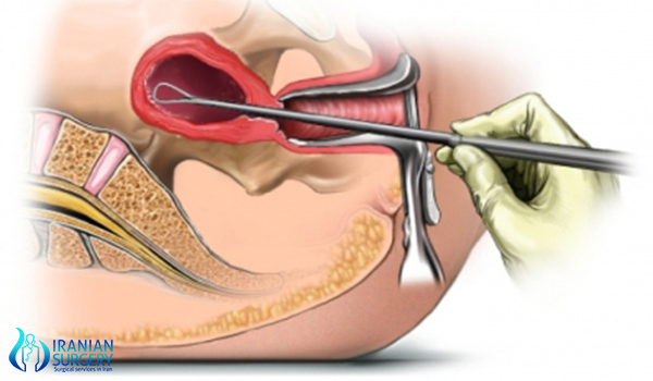 Before-the-dilation-and-curettage-procedure-in-iran