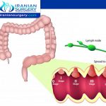 مراحل سرطان القولون