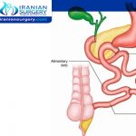 Biliopancreatic Diversion with Duodenal Switch (BPD/DS) Surgery