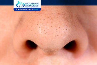 Blackheads after rhinoplasty