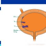 Bladder Cancer Staging