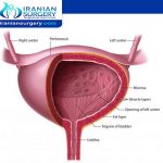 Bladder cancer