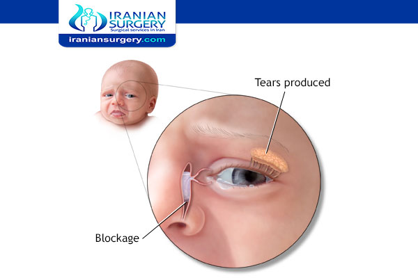 Blocked tear duct surgery in Iran