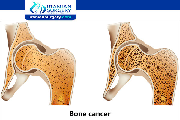 Bone cancer causes