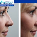 Botox after rhinoplasty