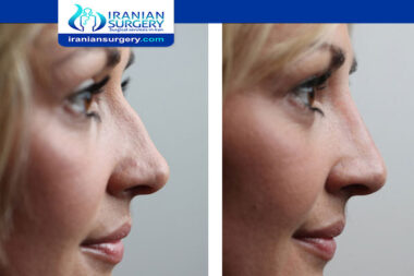 Botox after rhinoplasty