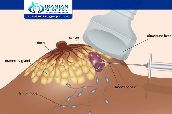 Breast biopsy in Iran