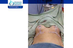 breast reduction surgery in iran