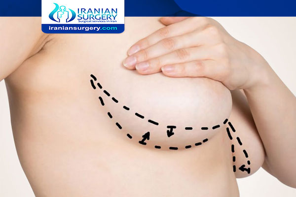 Breast reduction surgery in Iran
