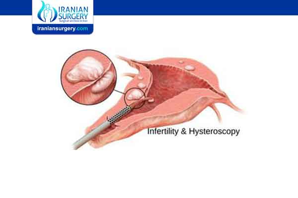 Can hysteroscopy help infertility?