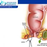 Can you pop a perianal abscess