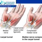 Carpal tunnel operation