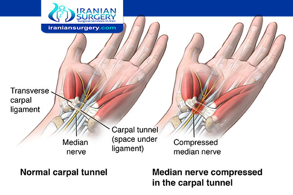 Carpal tunnel operation