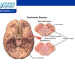 Causes and risk factors of Parkinson disease