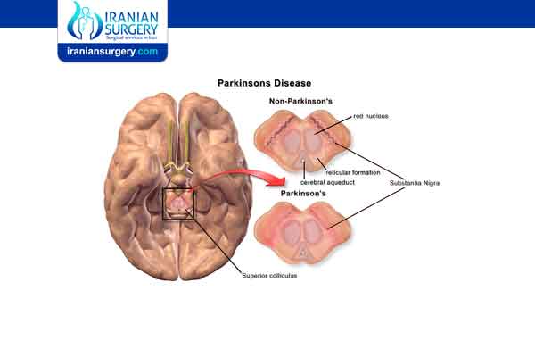 Causes and risk factors of Parkinson disease